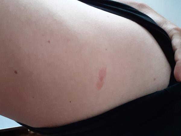 Môže to byť borelióza?