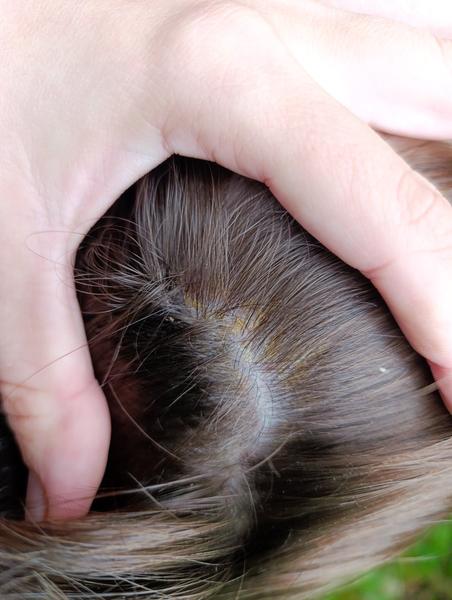 Lupiny a vyrážky u detí