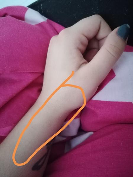 Po odbere krvi pociťujem mravečenie v palci