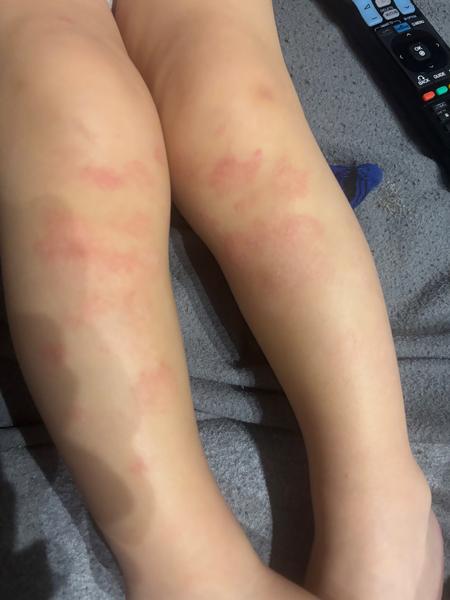 Červené fľaky u dvojročného