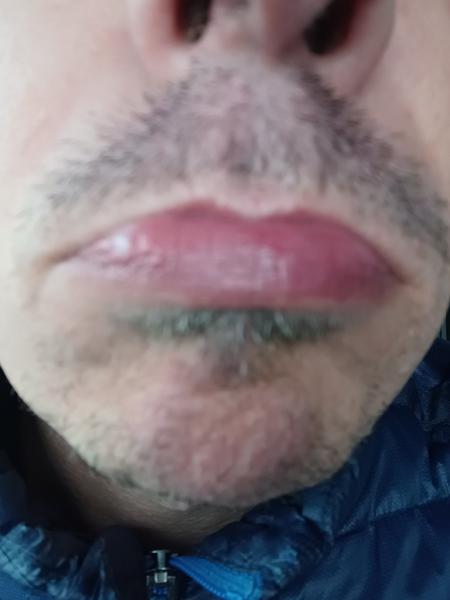 Z čoho sa mi vytvoril tvrdý biely útvar na dolnej pere?