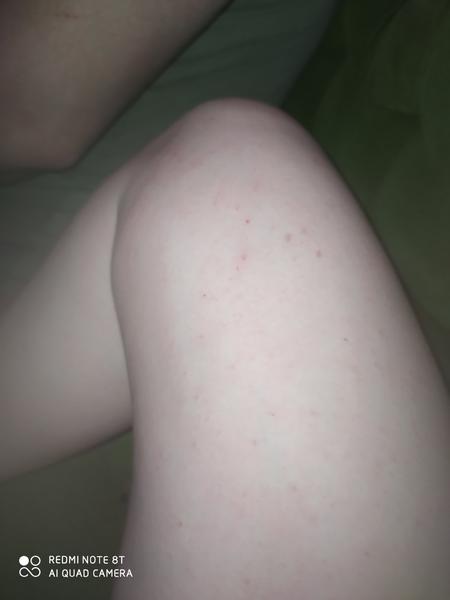 Aké sú to vyrážky?