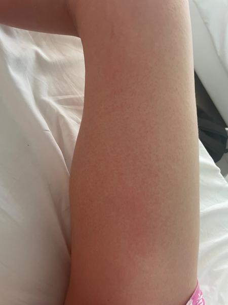 Môže Beloretin spôsobiť alergiu na tele?