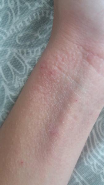 Je to ekzém na zápästí?