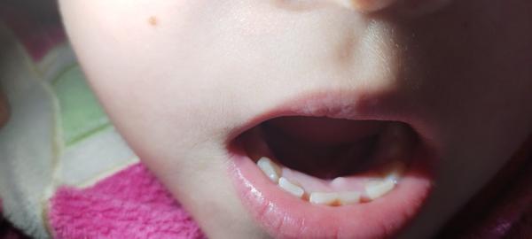 Nesprávny rast zubu u dieťaťa