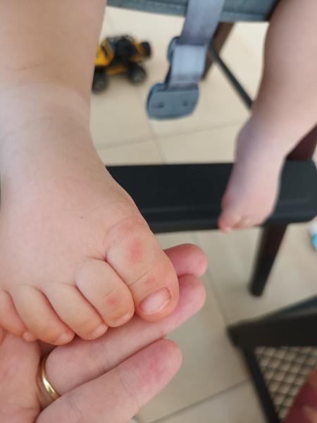 Prečo sa 11-mesačnému synovi šúpe koža?