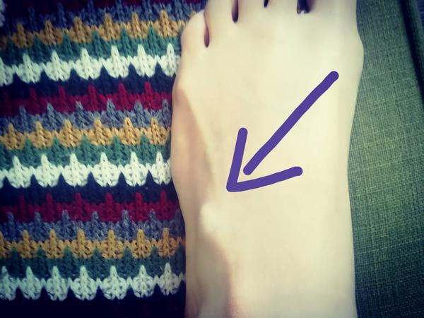 Hrčka na priehlavku