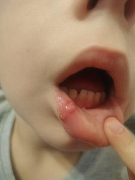 Môže sa vytvoriť herpes za pár hodín?