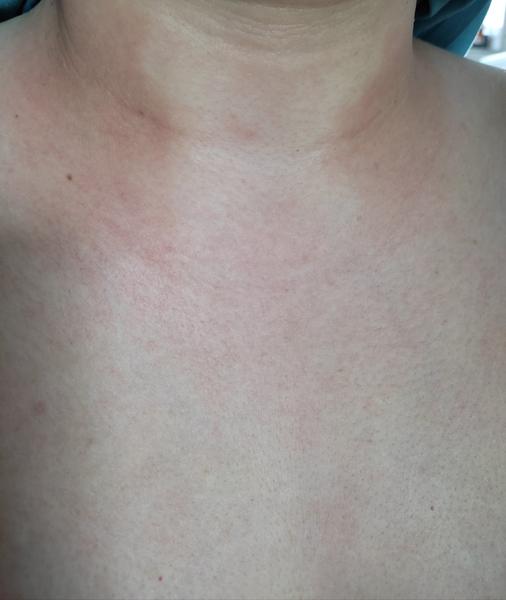 Čo spôsobuje červené fľaky na krku?