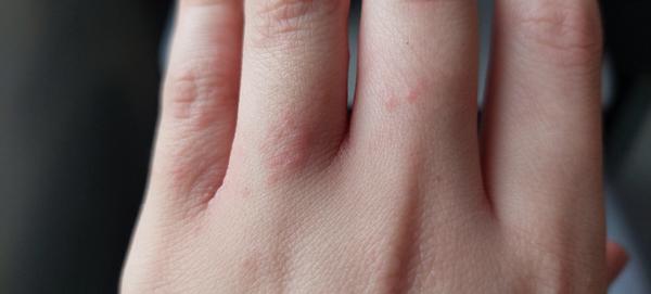 Sú vyrážky na prstoch rúk prejavom možnej alergie?