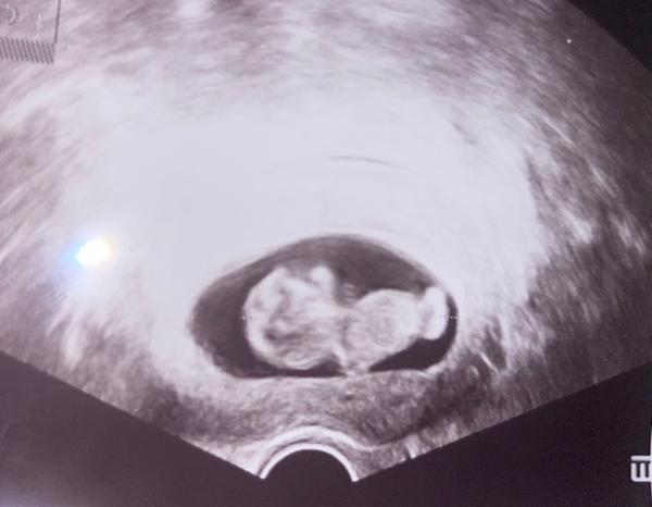 Bude to chlapček alebo dievčatko?