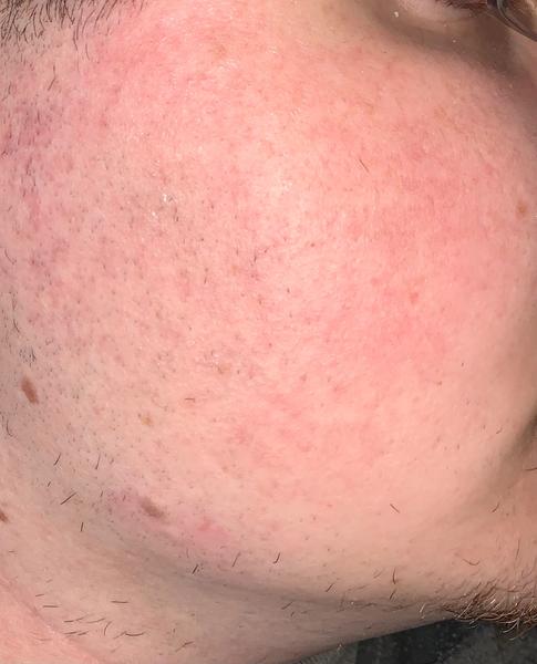Je to naozaj rosacea? Skúsenosti a rady.