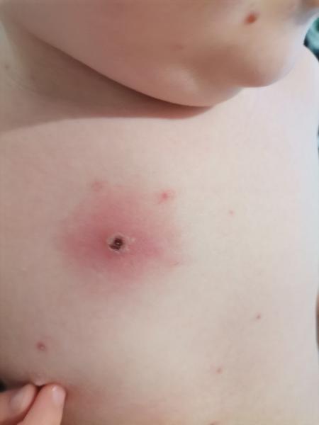 Prečo je jedna z vyrážok pri kiahňach takto zapálená?