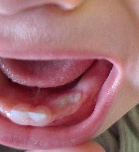 Čo môže znamenať biely útvar na ďasne?