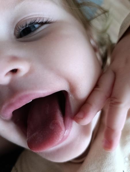 Fľaky na jazyku u 13-mesačnéhé dojčeného dieťaťa