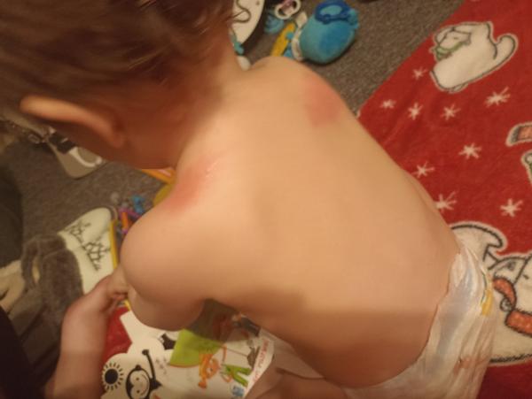 Čo spôsobuje červené fľaky u dieťaťa?