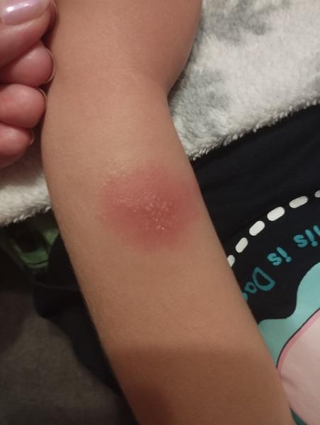 Od čoho sú tieto štípance?