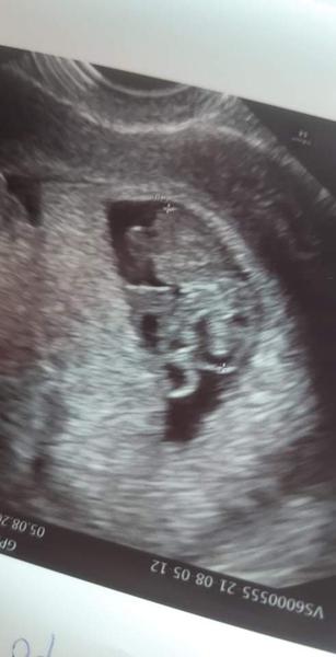 Čo znamená bublinka na hlave plodu?