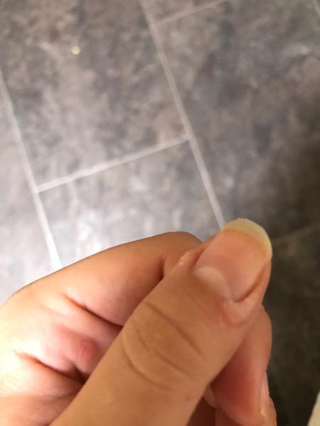 Čo to mám pri nechtoch?