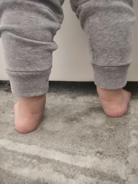 Dvojročná dcérka má zakrivené chodidlá. Aký je Váš názor?