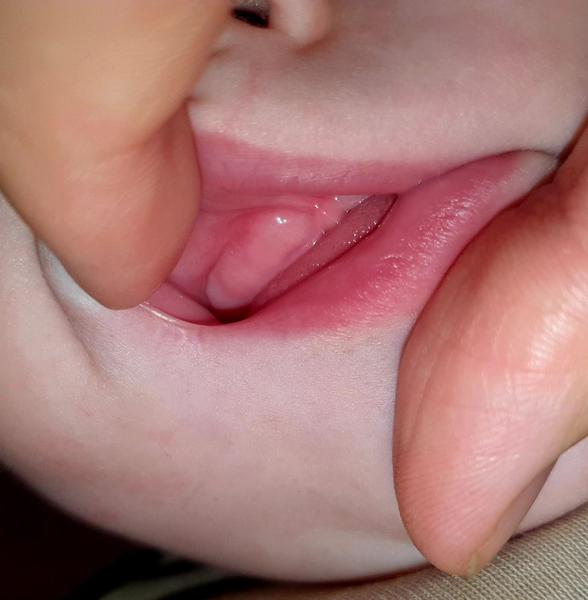 Môžu sa dcérke ako prvé prerezávať horné zuby?