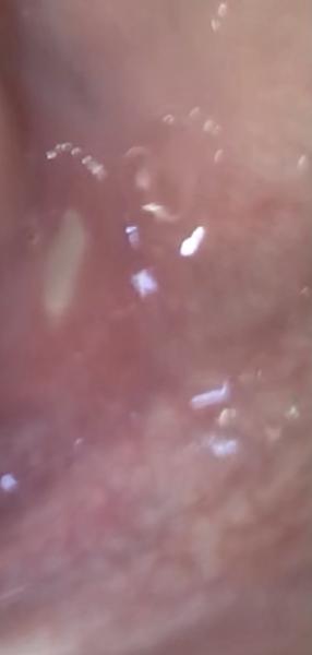 Čo spôsobuje bielu škvrnu na ďasne?