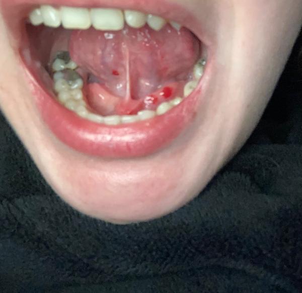 Prečo sa mi robia krvné podliatiny v ústach?