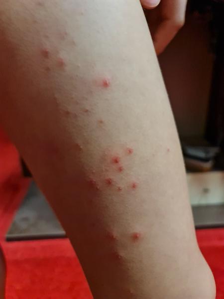 Vyrážky u 8-ročného na bedrách, stehnách, zadočku, na spodnej strane ramien