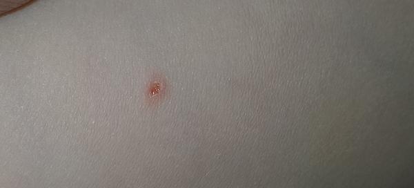 Čo spôsobilo vyrážku na nohe syna?