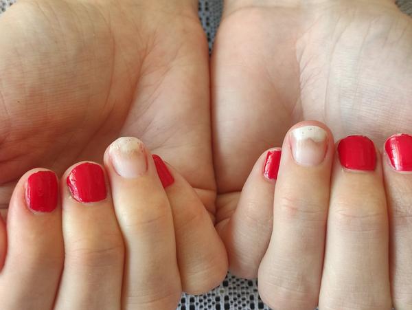 Ako liečiť onycholýzu?