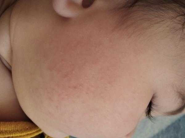 Aké vyrážky má moje 8 mesačné bábätko?
