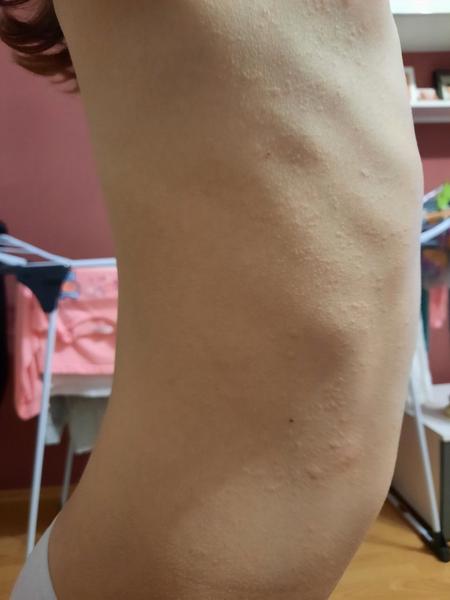 Kožné problémy na bruchu a po bokoch