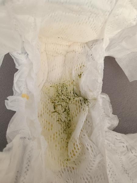 Zmena stolice u dieťaťa po antibiotikách: Čo robiť?