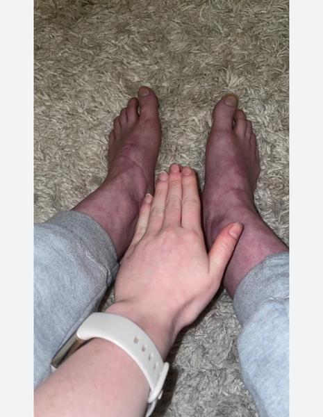 Je normálne mať takto prekrvené nohy?