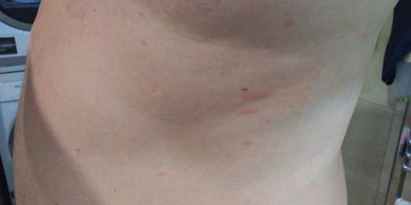 Čo sú to za vyrážky?