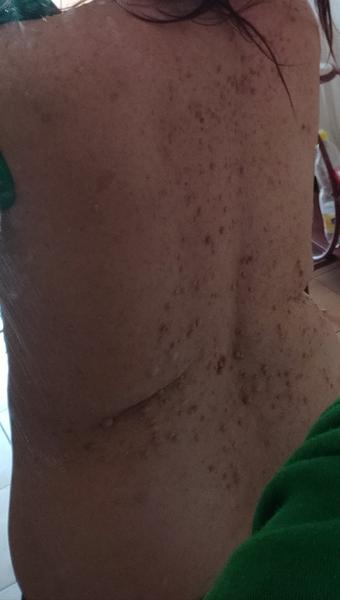 Aké znamienka sa mi vyhodili počas tehotenstva na koži?