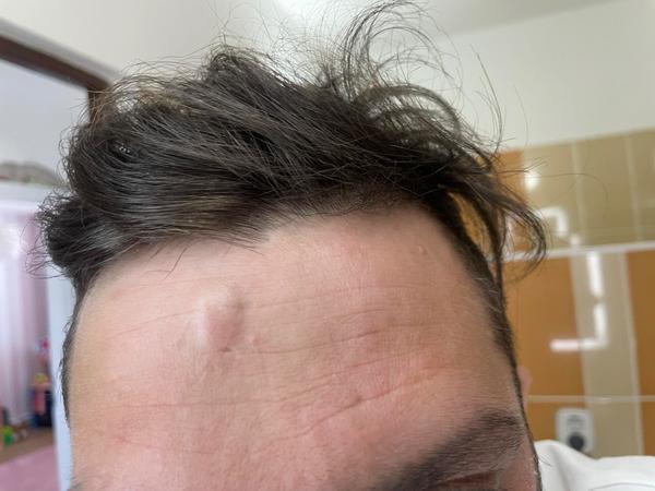 Čo znamená hrčka na čele môjho manžela?