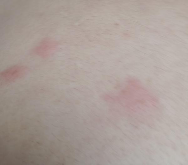 Od čoho môžu byť tieto štípance?