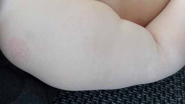 Ročný syn má už 2 týždne fľaky po rukách a na bruchu