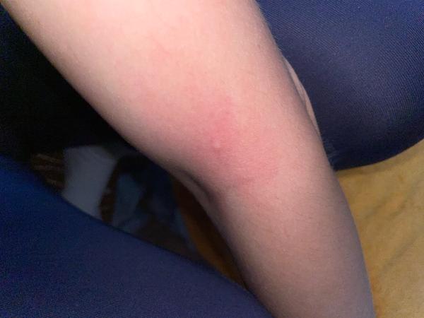 Je to komár, ploštica alebo blcha?