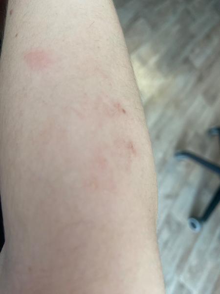 Zvláštne vyrážky a ich súvis s alergiami