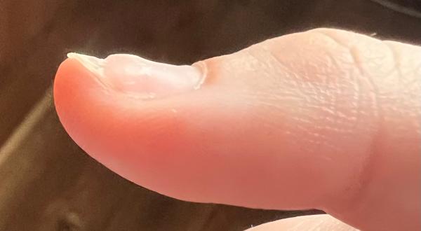 Čo môže spôsobovať zmeny na nechte?