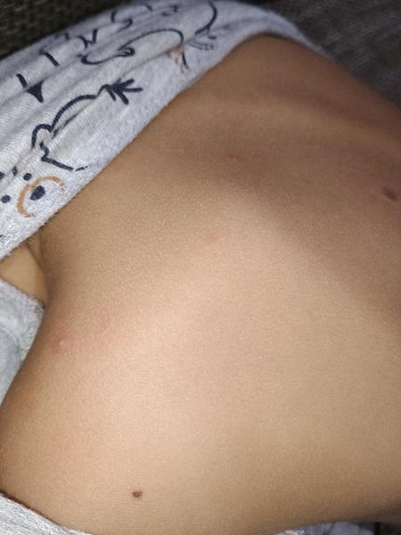 Sú to kiahne alebo nie? Ako postupovať?