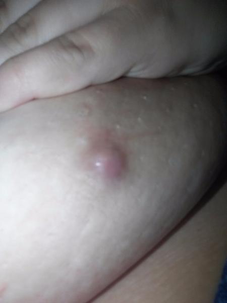 Hrčka - vyrážka na prsníku