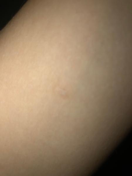 Aké vyrážky sa mi to tvoria na rukách?