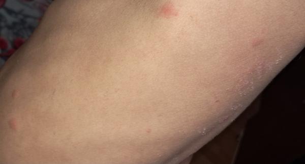 Čo spôsobuje neznáme štípance?