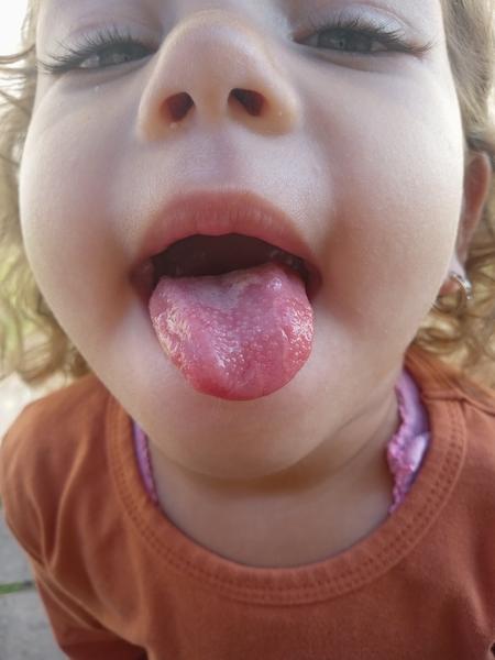 Vyrážky na jazyku 2,5-ročnej dcérky