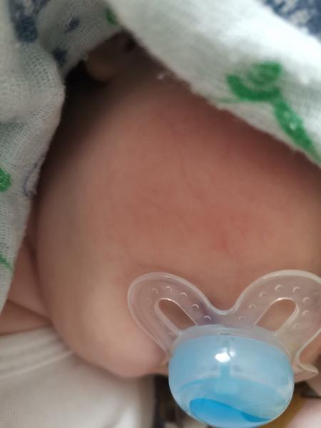 Žilky na tváričke 2-mesačného bábätka