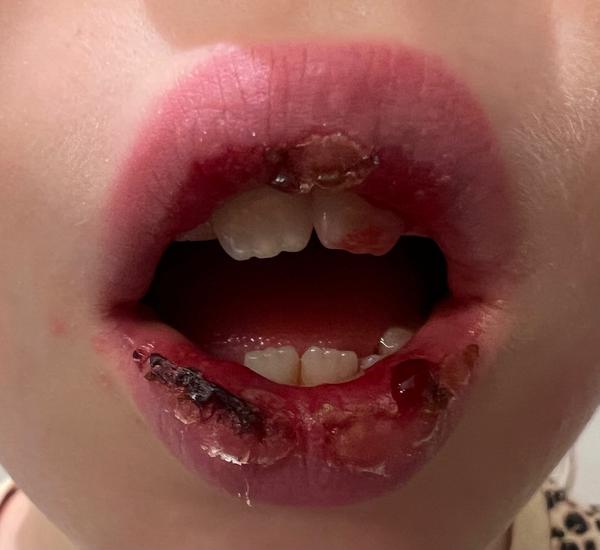 Popraskané krvácajúce pery u detí počas choroby