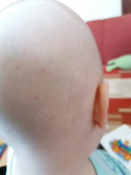 Vodnatá vyrážka u 1,5-ročného.